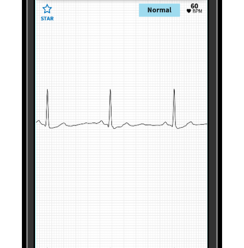Review: AliveCor Mobile ECG Monitor (3rd gen)