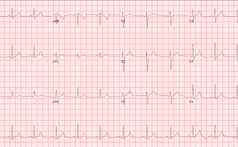 The Normal Ecg The Student Physiologist