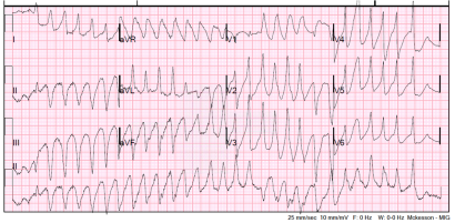 12-lead in polymorphic VT-later
